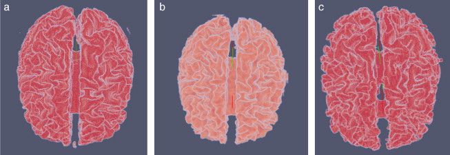Vista volumétrica de la zona de la materia blanca. (a) Volumen original de la ...