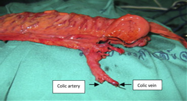 Preparing mesocolon pedicle for vascular enhancement (left arrow, colic artery; ...