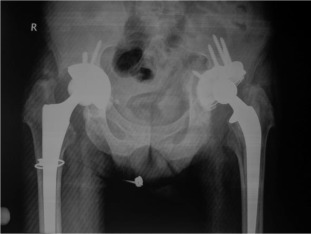 Six years after right side, five years after left side THA.