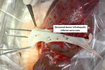 Completed graft hepatic vein to inferior vena cava anastomosis.
