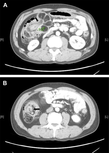 Contrast-enhanced abdominal computed tomography showing (A) intussusception of ...