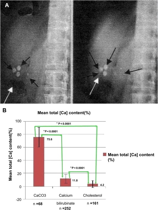KUB film radio-opacity and stone total calcium content in patients with ...