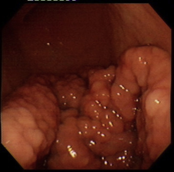 Endoscopic finding in this gastritis cystica polyposa (GCP) patient. Diffuse ...