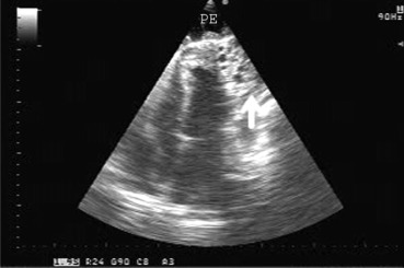 Transthoracic four-chamber echocardiographic view showing the large pericardial ...
