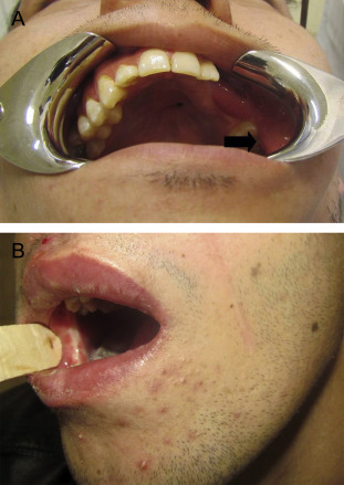 Scar in buccal mucosa related to the superiorly-based FAMM flap. (A) Left side. ...