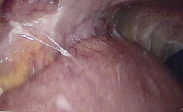 Laparoscopy. The omentum is adherent to the abdominal wall.