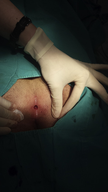 After the pit excision and curettage of the sinus.