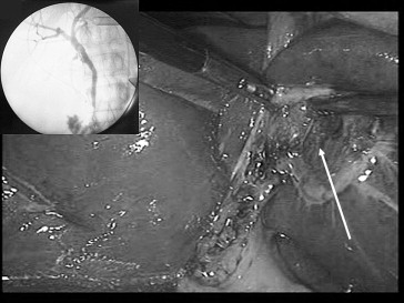 After cholecystectomy, the photo shows the gallbladder bed (White arrow) to ...