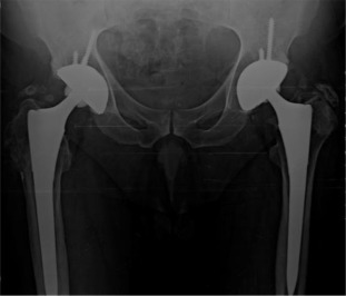 Brooker type 1 heterotopic ossification on the right and type 2 on the left ...