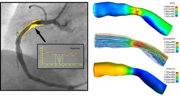 Streamline and wall shear stress in a coronary artery