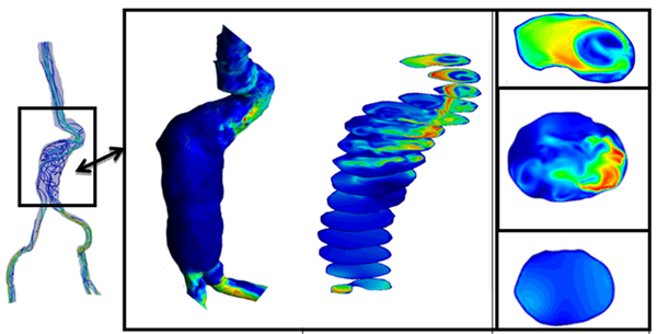 Diagnostic Indicators in Aortic Abdominal Aneurysm. Streamlines, wall shear stress and velocity profiles at different sections of the aneurismatic sac.