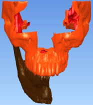 Mandibular resection.