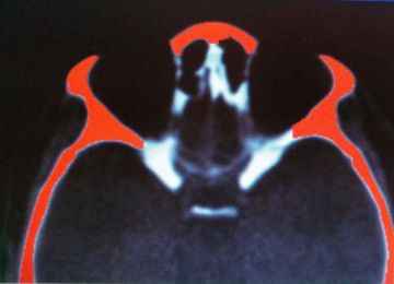 Cross view of Computer Axial Tomography Reconstruction.\label{F2a}