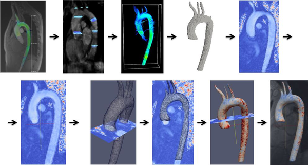 Preliminary concept of automatic segmentation of the Aorta based on 4D MRI data
