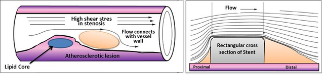 Left, Atherosclerosis lesion. Right, Flow around rectangular section of stent