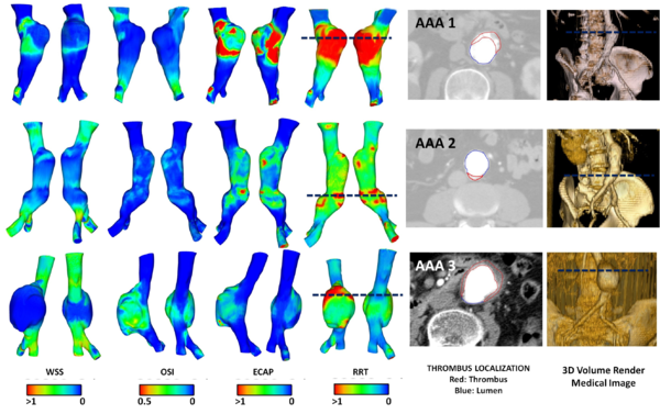 Spatial distribution of WSS, OSI, ECAP and RRT in three abdominal aortic aneurysm. For each AAA, anterior and posterior views of the lesions. On the right, 3D volume render and a CT slice showing the localization of the incipient thrombus (red line: thrombus, blue line: lumen). Dark Blue line represents the localization of the CT slice.